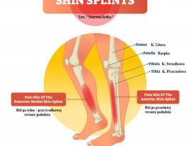 Shin Splints – problem wielu biegaczy